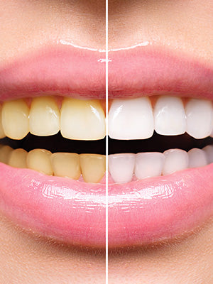 Teeth whitening - Mela Beauty Course